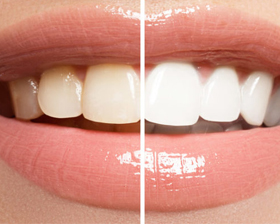 Clareamento Dental